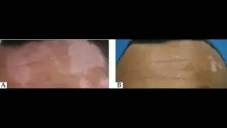 Vitiligo Treatment Cream 2016 new method