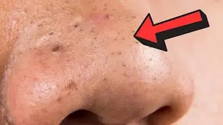 La Mejor ELIMINACIÓN de ESPINILLAS y PUNTOS NEGROS #ACNE 2023 - ESPINILLAS NEGRAS
