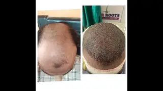 hair transplant #my experience #panwa tech
