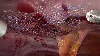 Laparoscopic prosthetic repair of the diastasis of the rectus abdominal muscles with transfix points