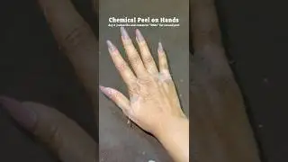 TCA 25% Chemical Peel on Hands - Day 3 Peeling Update! ✨ 
