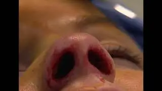 Norman Pastorek - Endonasal Rhinoplasty Pt.2