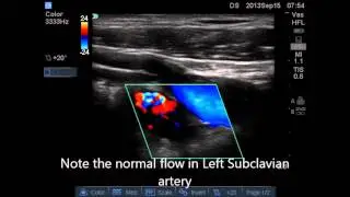 Emergency Ultrasound Case: Acute Upper Limb Ischemia