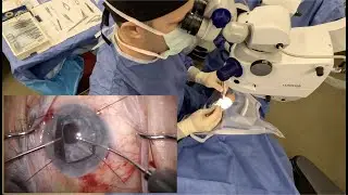 Removal of white cataract and placement of iris prosthesis in patient with atrophic iris