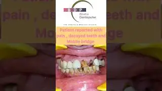 Absolute Smile Makeover for front teeth #smile #smilemakeover #teeth