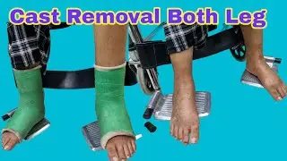 Cast removal both leg