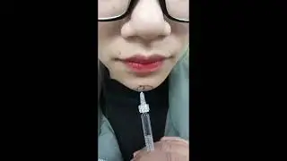 chin filler injection