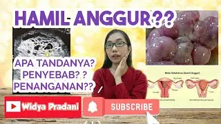 KEHAMILAN ANGGUR (MOLA HIDATIDOSA) | PENYEBAB-FAKTOR RESIKO, TANDA-GEJALA, TINDAKAN PENANGANAN