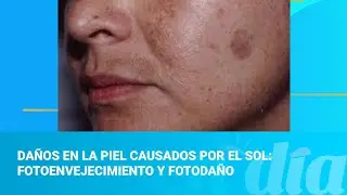 Skin damage caused by the sun: photoaging and photodamage