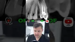 Navigating Canal Connections with CBCT Insights