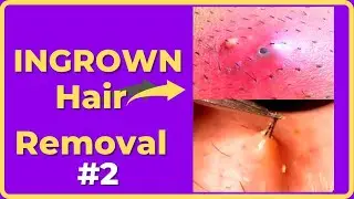 Ingrown hair removal videos [Compilations #2]  #ingrownhair #Compilations