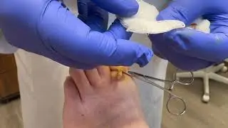 Diseased fungal toenail removal surgery by podiatric surgeon