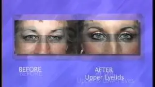 What is Eyelid Surgery