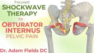 Shockwave for Obturator Internus Tendon and Myofascial Trigger Points | Pudendal Neuralgia