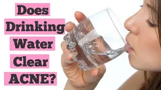 Does Drinking Water Help Clear Up Acne? | Detox Water for Clear Skin | Acne Diet