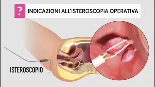 Isteroscopia operativa, quando è indicata e come si esegue
