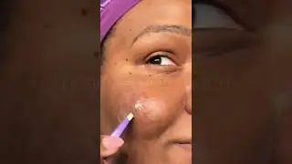 Pimple patch chronicles returns (again) pt III | #omg #acnetreatment #pimplepatch
