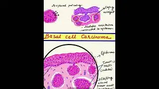 #letsdrawBCC #microscopymadeeasy #rodent ulcer Basal Cell carcinoma step by step | DR.MITHILA |