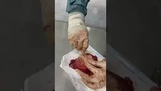 Uşaqlığın hiperplaziyası