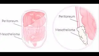 mesothelioma ad