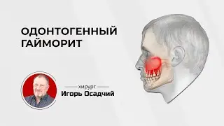 Одонтогенный или стоматологический гайморит