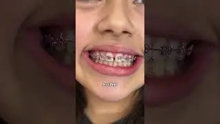 Braces Colors for Whiter looking teeth