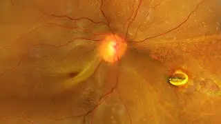 RETAINED MAGNETIC INTRAOCULAR FOREIGN BODY WITH RETINAL DETACHMENT AND SIDEROSIS BULBI