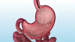 Endoscopic Therapy For Weight Loss: Single Balloon Placement
