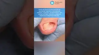 Грибок ногтей #shorts #short #shortvideo #грибокногтей #дерматология #подология #подологмосква