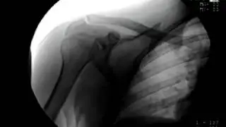 3q 02Shoulder Carriage: Flouroscopic Xray Three Quarter 02