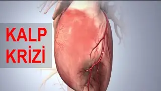 Heart Attack
