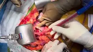 Karaciğer kanseri için organ koruyucu temizlik | Prof Dr Ünal Aydın