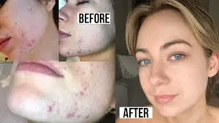 MY ACNE SKINCARE ROUTINE - THE BEST PRODUCTS THAT FINALLY CLEARED MY SKIN 2020