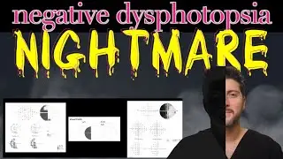 Unusual Complication after Refractive Lens Exchange - Incredible!