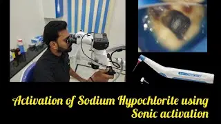 Sodium Hypochlorite Activation using Sonics & Champagne Bubble Test in Endodontics#rct for beginners