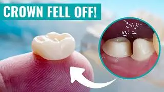 Why Did My Dental Crown Fall Off?