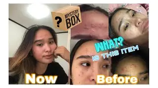 Breakouts NO MORE!!! Super effective rejuvenating set in just 7 DAYS | Ms.V Pancho
