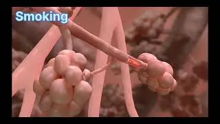 smoking causes copd #copd #chronicbronchitis #smoking #3danimation #disease #pulmonarydisease