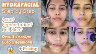 HYDRAFACIAL: Step-by-Step | Is this WORTH it? (Before & After Results) + Pricing
