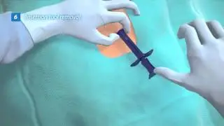Reveal LINQ Insertion Animation