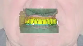 Implant case #1: Roll the dice