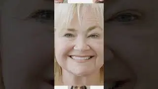 Part 2: Top 5 smile transformations🙌🏻😁 