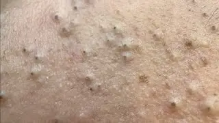 Blackhead Extraction Ultimate Removal  Blackhead & Pimples Safe Methods!!
