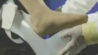 WalkAide treats Foot Drop using Myo Orthotics Technology