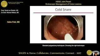 Standard polypectomy techniques: Choosing the right technnique