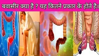 बवासीर क्या है कैसे होता है।। बवासीर कितने प्रकार का होता है।