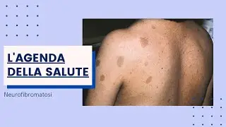 Neurofibromatosi: le ultime novità sul fronte della ricerca