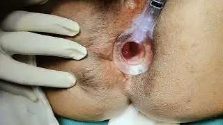 MULTIPLE SURGERIES|FISTULA IN ANO & PILES|SCARRING OF ANAL CANAL|#drsachin+919419135050 #patanjali.