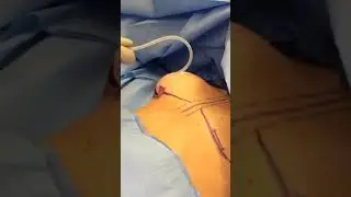 Filling an Implant Sizer 