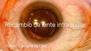 Recambio de LIO monobloque plegable en surco por LIO 3 piezas